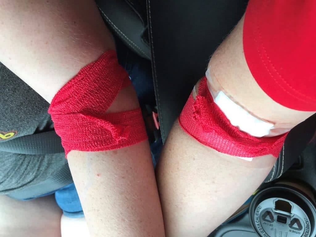 Nigel and her daughters arms after a blood donation. 
