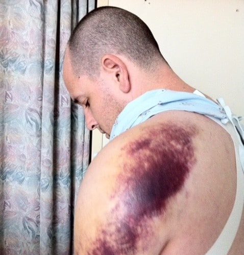 Nigel's husband Nigel displaying his shoulder injury after the accident.